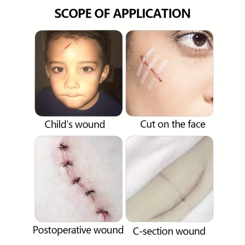 1 Pack, Self-adhesive Tape For Skin Closure, Personal Kit Emergency Supplies, Sterile Low-to-sensitive Non-woven Tape, Skin Adhesive, C-section Suture Tape, Small Wound Closure Kit Cut, 0.61/1.19/2.11 Cm × 10.01 Cm